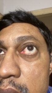 MY JOURNEY WITH A RARE TUMOUR BEHIND EYE 120 81902957 FC3E 45F8 8FE7 53955AA0ECA9