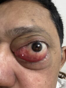 MY JOURNEY WITH A RARE TUMOUR BEHIND EYE 62 IMG 0049