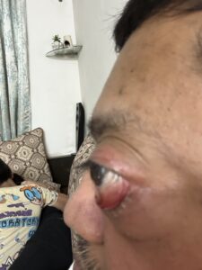 MY JOURNEY WITH A RARE TUMOUR BEHIND EYE 61 IMG 0051