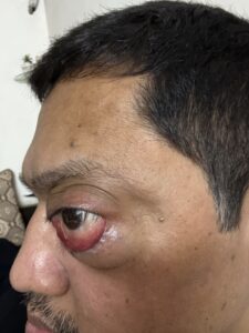 MY JOURNEY WITH A RARE TUMOUR BEHIND EYE 60 IMG 0053