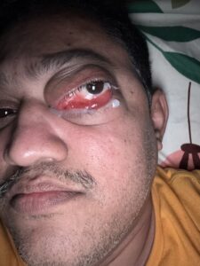 MY JOURNEY WITH A RARE TUMOUR BEHIND EYE 59 IMG 0110