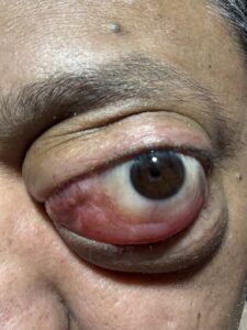 MY JOURNEY WITH A RARE TUMOUR BEHIND EYE 58 IMG 0571