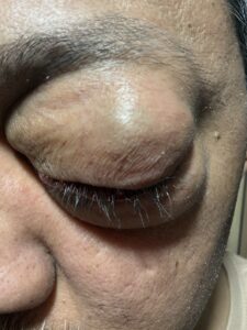 MY JOURNEY WITH A RARE TUMOUR BEHIND EYE 57 IMG 0572