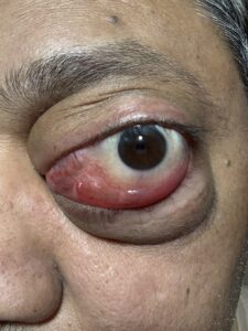 MY JOURNEY WITH A RARE TUMOUR BEHIND EYE 56 IMG 0573