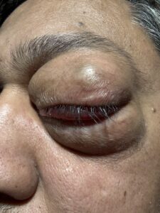 MY JOURNEY WITH A RARE TUMOUR BEHIND EYE 55 IMG 0575