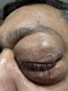 MY JOURNEY WITH A RARE TUMOUR BEHIND EYE 54 IMG 0576