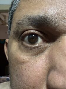 MY JOURNEY WITH A RARE TUMOUR BEHIND EYE 53 IMG 0577