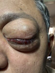 MY JOURNEY WITH A RARE TUMOUR BEHIND EYE 52 IMG 0578