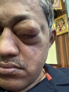 MY JOURNEY WITH A RARE TUMOUR BEHIND EYE 51 IMG 0640