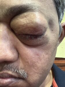MY JOURNEY WITH A RARE TUMOUR BEHIND EYE 50 IMG 0641
