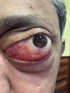 MY JOURNEY WITH A RARE TUMOUR BEHIND EYE 49 IMG 0642