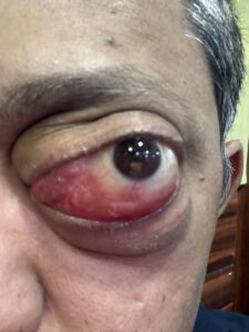 MY JOURNEY WITH A RARE TUMOUR BEHIND EYE 48 IMG 0643