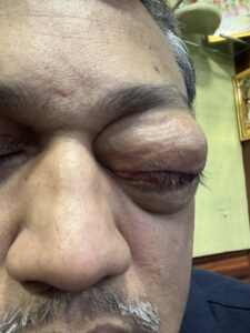 MY JOURNEY WITH A RARE TUMOUR BEHIND EYE 47 IMG 0646