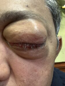 MY JOURNEY WITH A RARE TUMOUR BEHIND EYE 46 IMG 0648