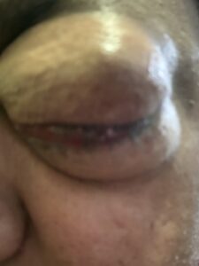 MY JOURNEY WITH A RARE TUMOUR BEHIND EYE 45 IMG 0828