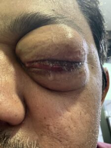 MY JOURNEY WITH A RARE TUMOUR BEHIND EYE 44 IMG 0829