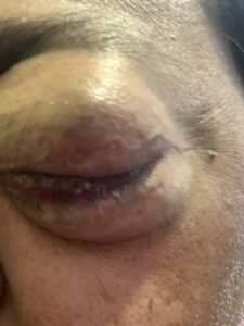 MY JOURNEY WITH A RARE TUMOUR BEHIND EYE 43 IMG 0830