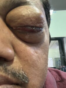 MY JOURNEY WITH A RARE TUMOUR BEHIND EYE 42 IMG 0832