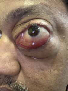 MY JOURNEY WITH A RARE TUMOUR BEHIND EYE 41 IMG 0833