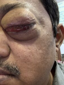 MY JOURNEY WITH A RARE TUMOUR BEHIND EYE 40 IMG 0835