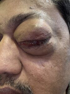 MY JOURNEY WITH A RARE TUMOUR BEHIND EYE 39 IMG 0836