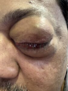 MY JOURNEY WITH A RARE TUMOUR BEHIND EYE 38 IMG 0837