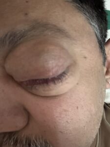 MY JOURNEY WITH A RARE TUMOUR BEHIND EYE 37 IMG 0873
