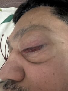 MY JOURNEY WITH A RARE TUMOUR BEHIND EYE 36 IMG 0874