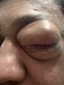 MY JOURNEY WITH A RARE TUMOUR BEHIND EYE 35 IMG 0876