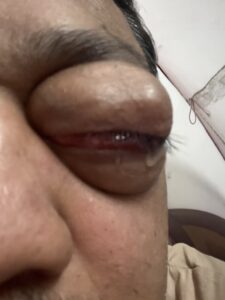 MY JOURNEY WITH A RARE TUMOUR BEHIND EYE 34 IMG 0878