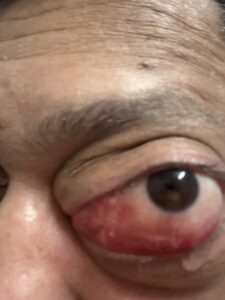MY JOURNEY WITH A RARE TUMOUR BEHIND EYE 33 IMG 0879