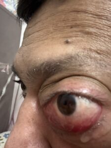 MY JOURNEY WITH A RARE TUMOUR BEHIND EYE 32 IMG 0880