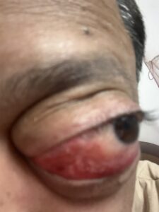 MY JOURNEY WITH A RARE TUMOUR BEHIND EYE 31 IMG 0881