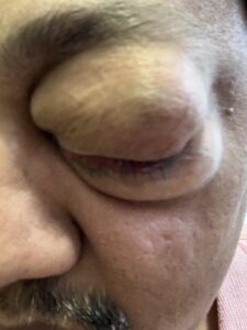 MY JOURNEY WITH A RARE TUMOUR BEHIND EYE 30 IMG 1035