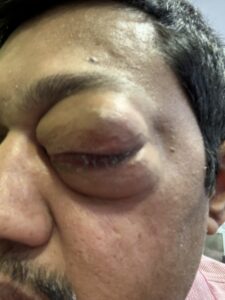 MY JOURNEY WITH A RARE TUMOUR BEHIND EYE 29 IMG 1036