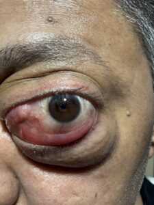 MY JOURNEY WITH A RARE TUMOUR BEHIND EYE 28 IMG 1089