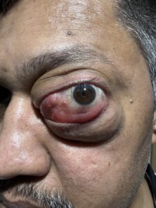 MY JOURNEY WITH A RARE TUMOUR BEHIND EYE 27 IMG 1091