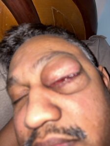 MY JOURNEY WITH A RARE TUMOUR BEHIND EYE 26 IMG 1100