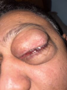 MY JOURNEY WITH A RARE TUMOUR BEHIND EYE 25 IMG 1102