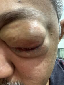 MY JOURNEY WITH A RARE TUMOUR BEHIND EYE 24 IMG 1109