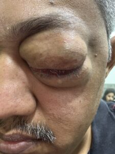 MY JOURNEY WITH A RARE TUMOUR BEHIND EYE 23 IMG 1110