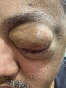 MY JOURNEY WITH A RARE TUMOUR BEHIND EYE 22 IMG 1111