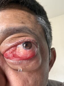 MY JOURNEY WITH A RARE TUMOUR BEHIND EYE 21 IMG 1274
