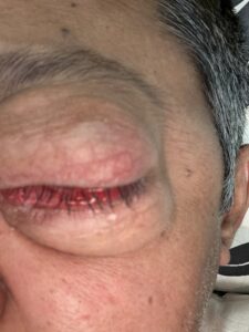 MY JOURNEY WITH A RARE TUMOUR BEHIND EYE 20 IMG 1293