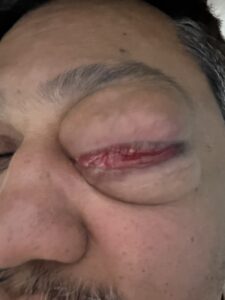 MY JOURNEY WITH A RARE TUMOUR BEHIND EYE 19 IMG 1294