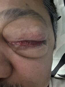 MY JOURNEY WITH A RARE TUMOUR BEHIND EYE 18 IMG 1296
