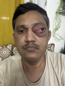 MY JOURNEY WITH A RARE TUMOUR BEHIND EYE 17 IMG 1302