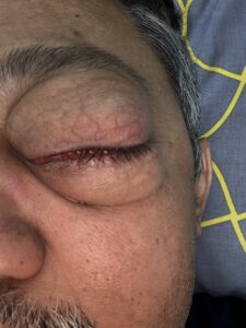MY JOURNEY WITH A RARE TUMOUR BEHIND EYE 16 IMG 1526