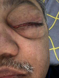 MY JOURNEY WITH A RARE TUMOUR BEHIND EYE 15 IMG 1527