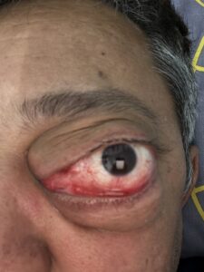 MY JOURNEY WITH A RARE TUMOUR BEHIND EYE 14 IMG 1531